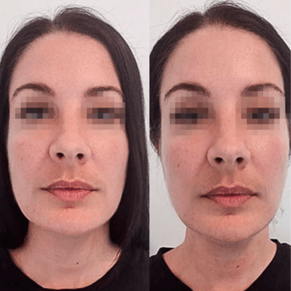 Drainage Lymphatique Liquide - Visage Affiné, Jambes Légères, Ventre Plat - Drainage